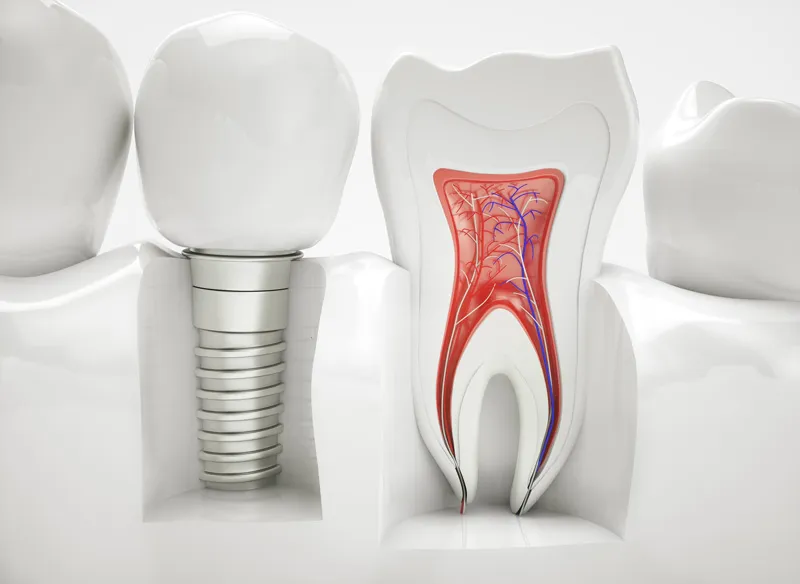 Zahnimplantat Köln topDentis Cologne