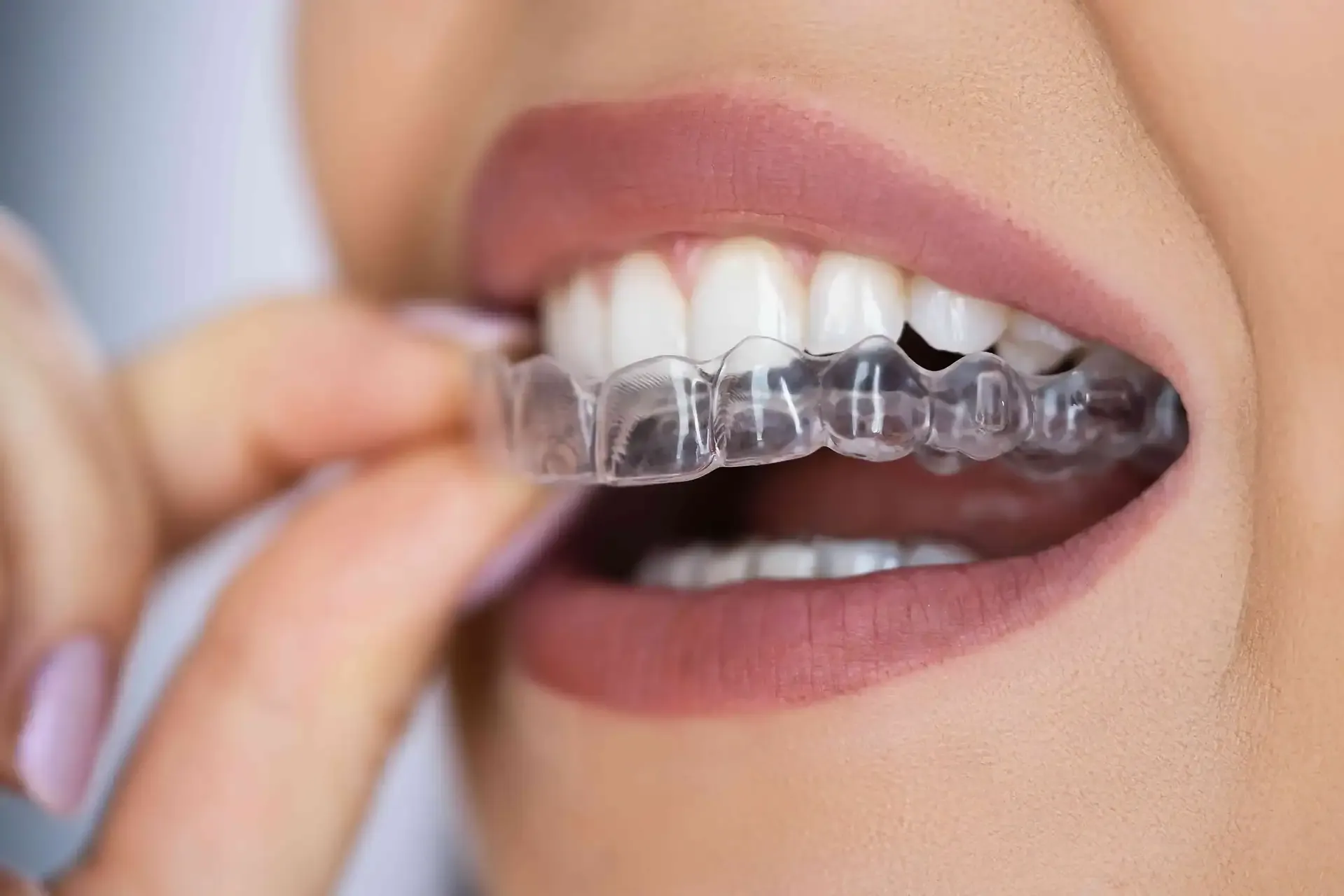 Invisalign in Köln