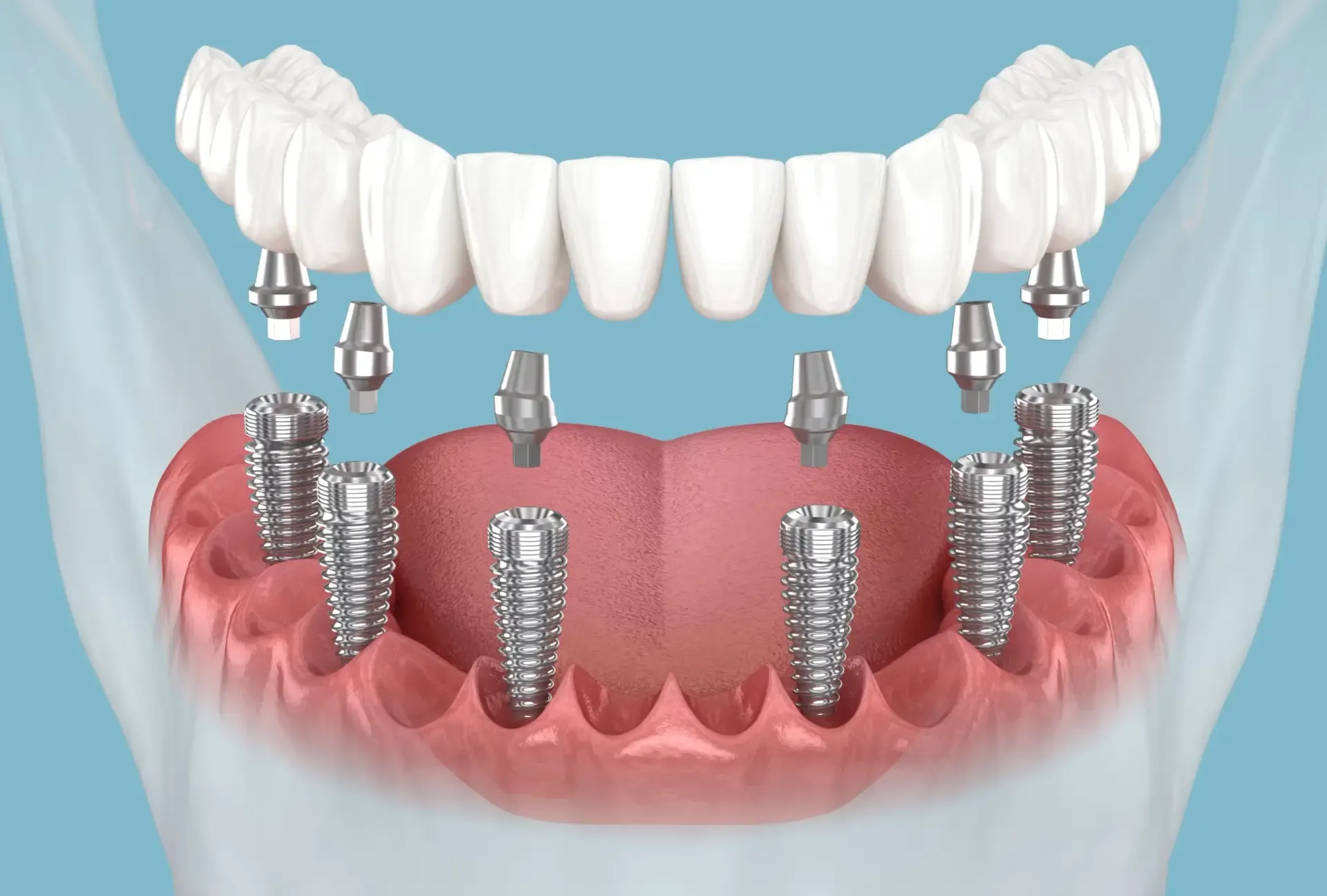 Implantate- die perfekte Lösung