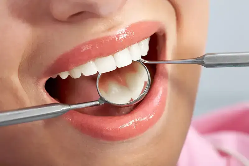 Professionelle Zahnreinigung in Köln - topDentis Cologne